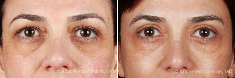 Eyelid Surgery (Blepharoplasty) Before & After Gallery - Patient 225746 - Image 1