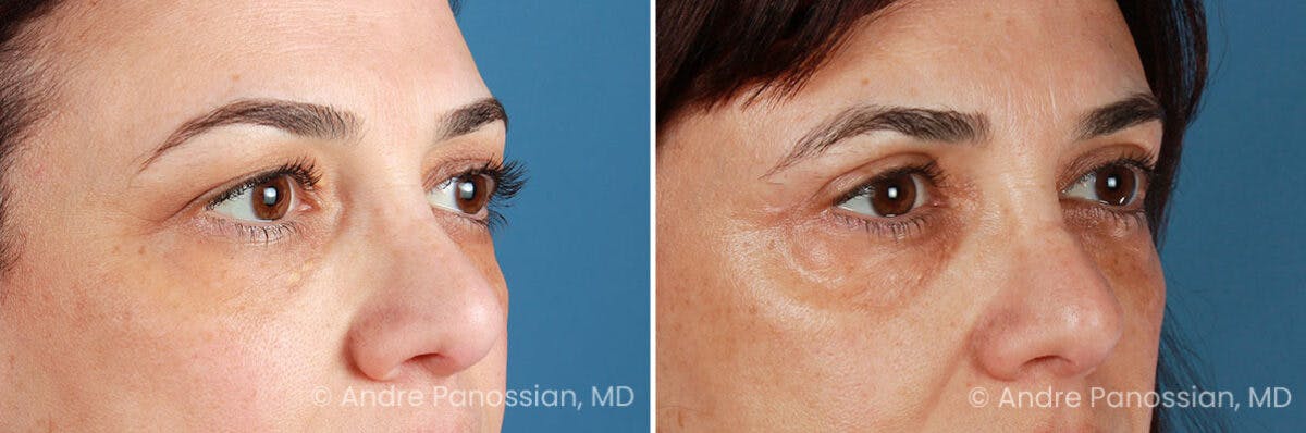 Eyelid Surgery (Blepharoplasty) Before & After Gallery - Patient 225746 - Image 2