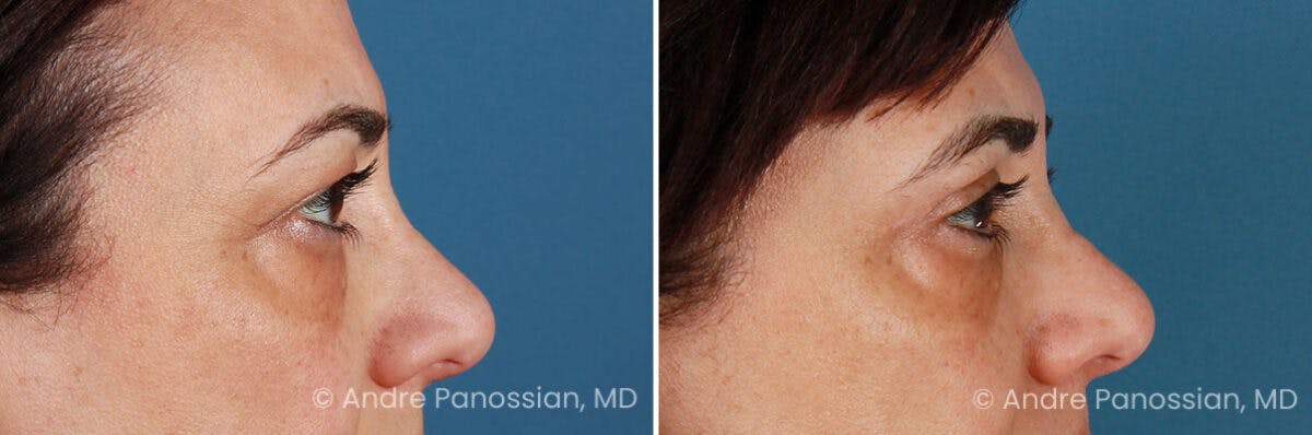 Eyelid Surgery (Blepharoplasty) Before & After Gallery - Patient 225746 - Image 3