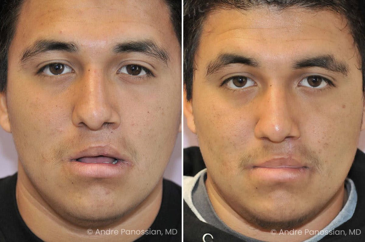 Revision Rhinoplasty Before & After Gallery - Patient 217770 - Image 2
