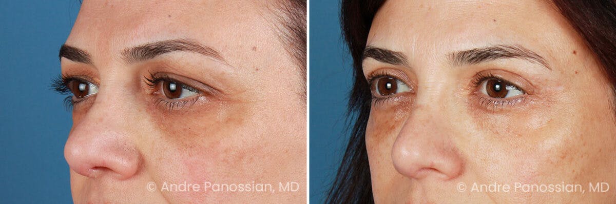 Eyelid Surgery (Blepharoplasty) Before & After Gallery - Patient 225746 - Image 4