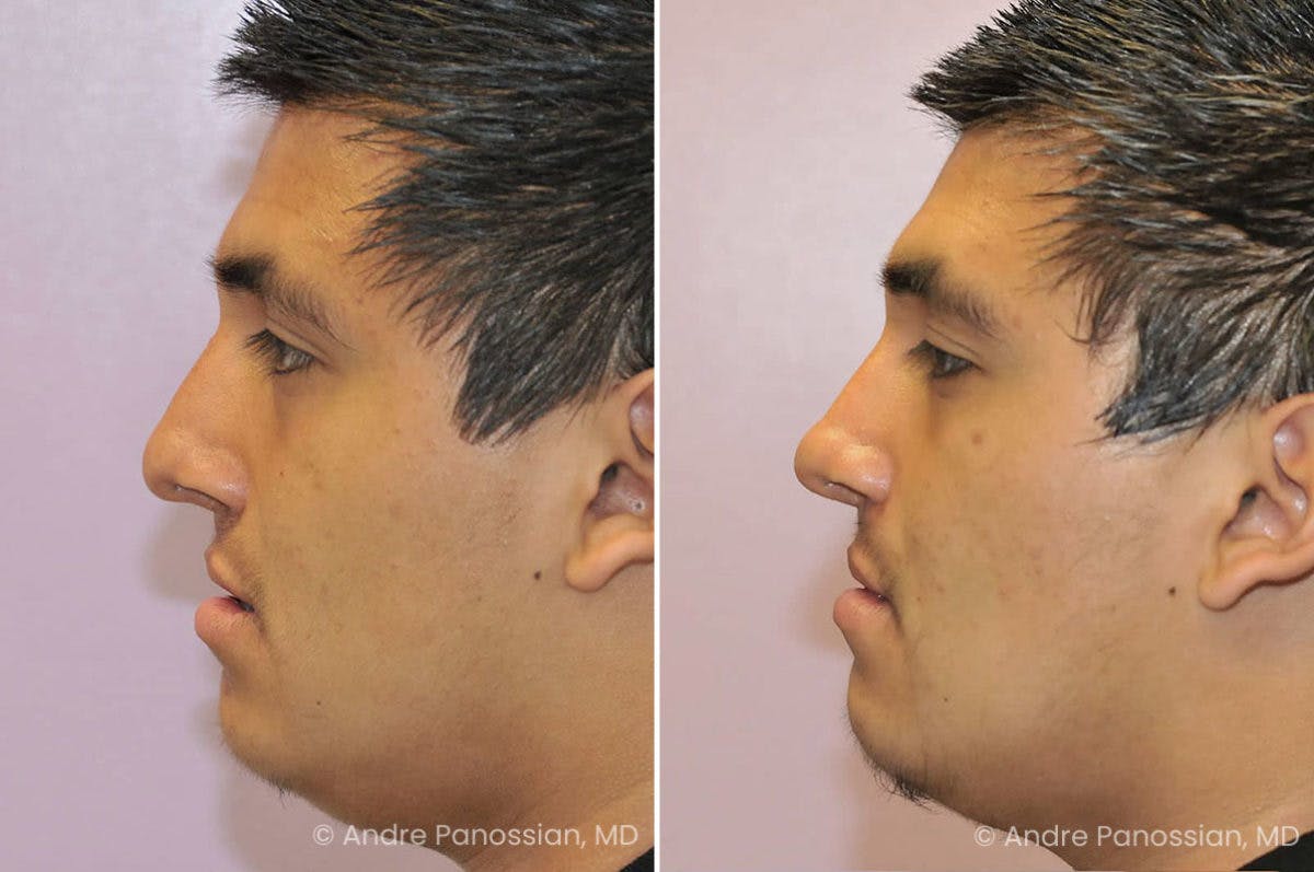 Revision Rhinoplasty Before & After Gallery - Patient 217770 - Image 1