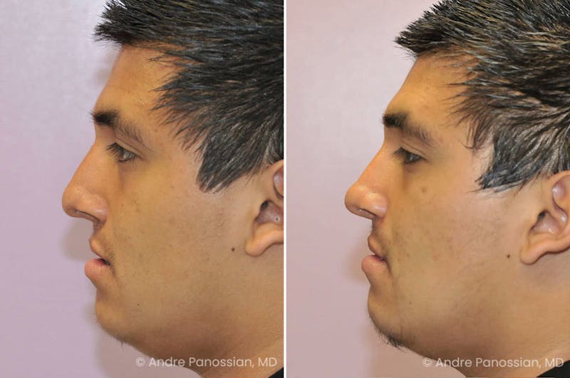 Revision Rhinoplasty Before & After Gallery - Patient 217770 - Image 1