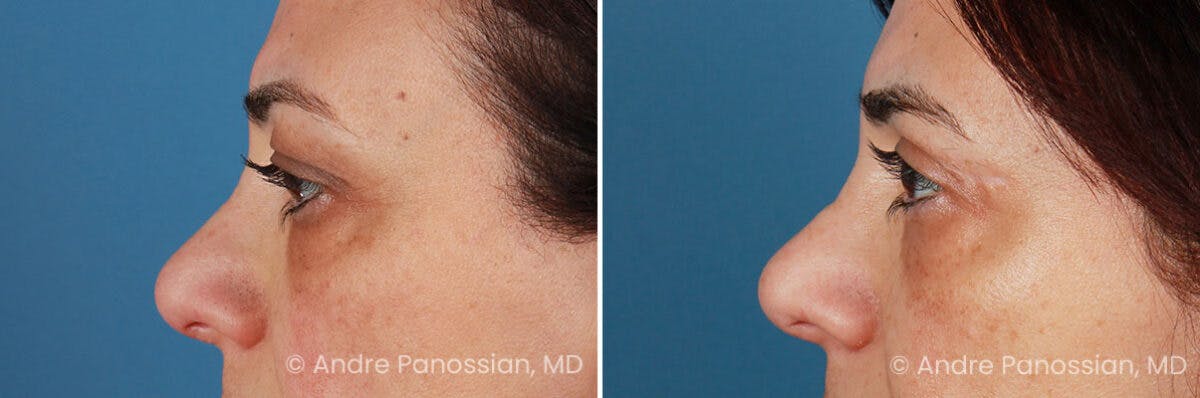 Eyelid Surgery (Blepharoplasty) Before & After Gallery - Patient 225746 - Image 5