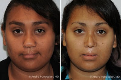 Cleft Lip Rhinoplasty Before & After Photos | Andre Panossian, M.D.