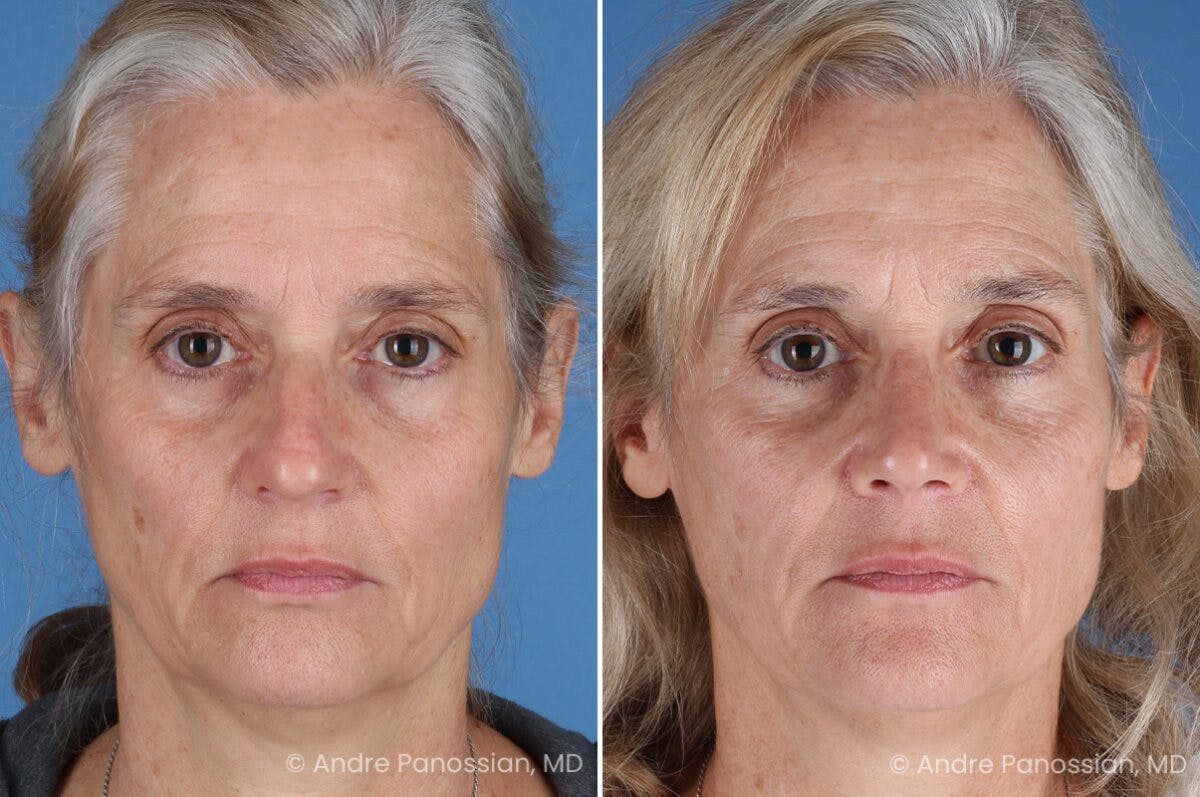 Rhinoplasty Before & After Gallery - Patient 350713 - Image 2