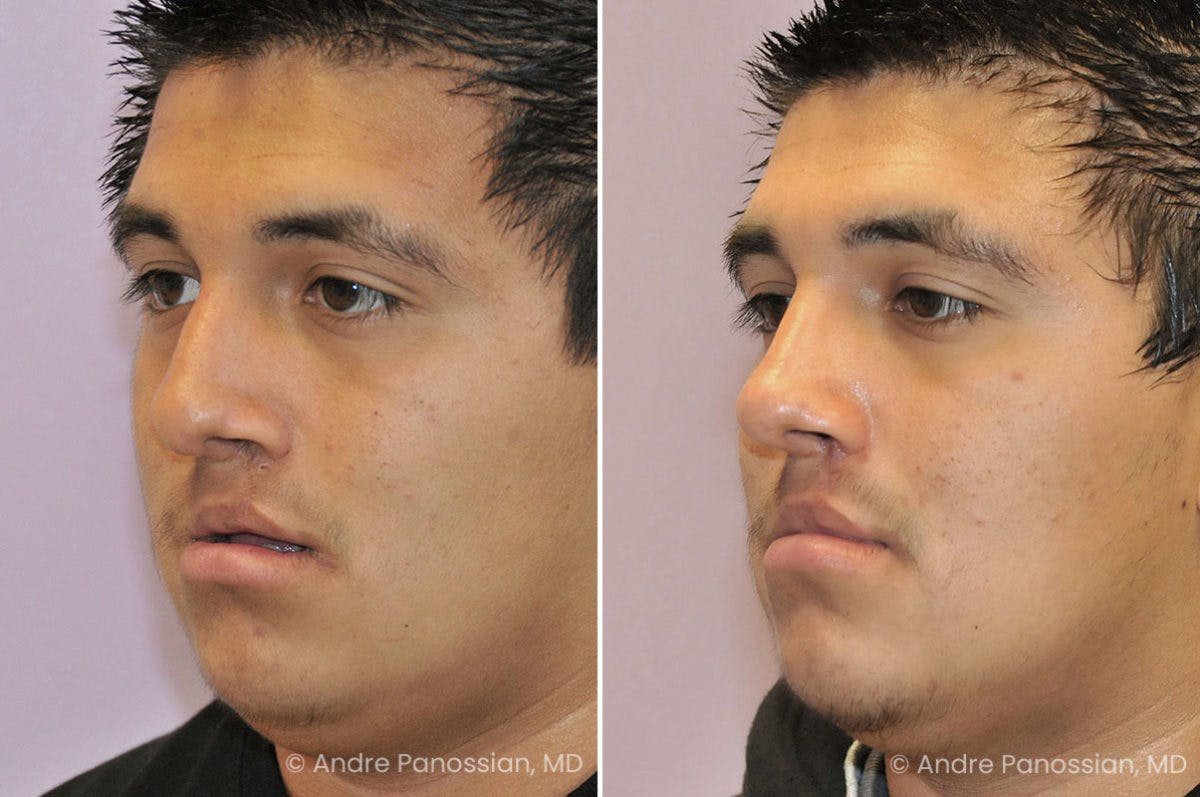 Revision Rhinoplasty Before & After Gallery - Patient 217770 - Image 3