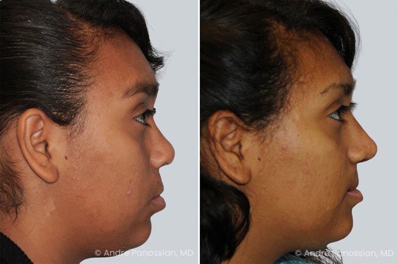 Cleft Lip Rhinoplasty Before & After Gallery - Patient 461917 - Image 1