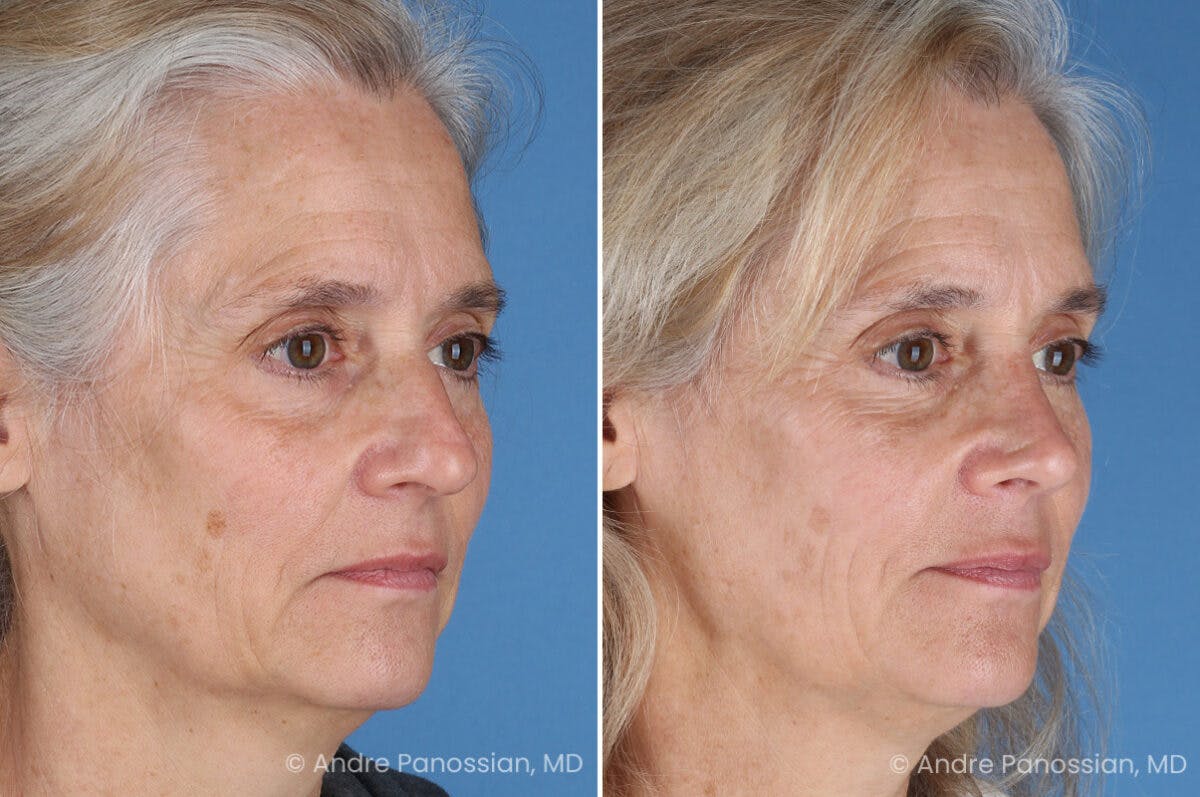 Rhinoplasty Before & After Gallery - Patient 350713 - Image 3