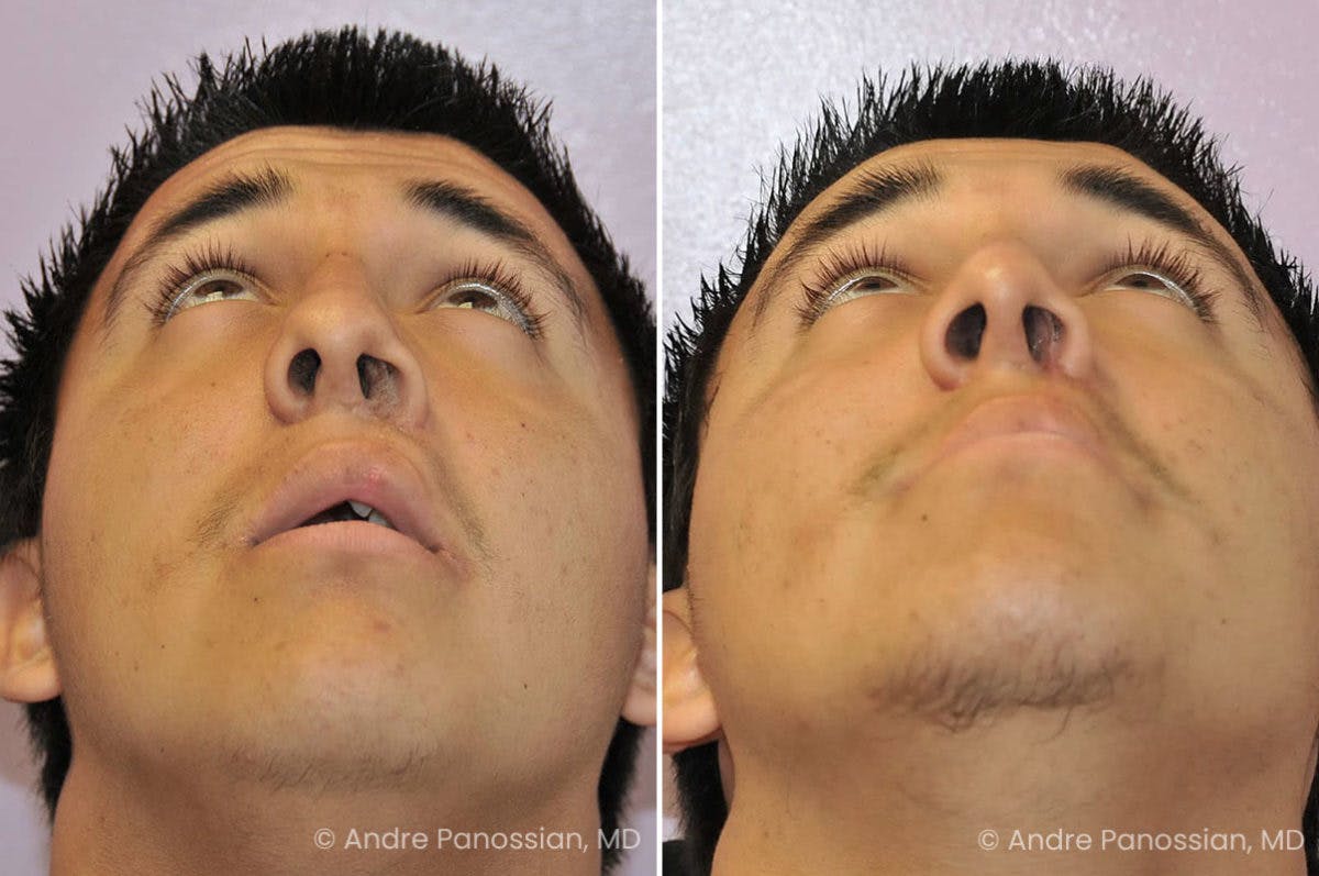 Revision Rhinoplasty Before & After Gallery - Patient 217770 - Image 4