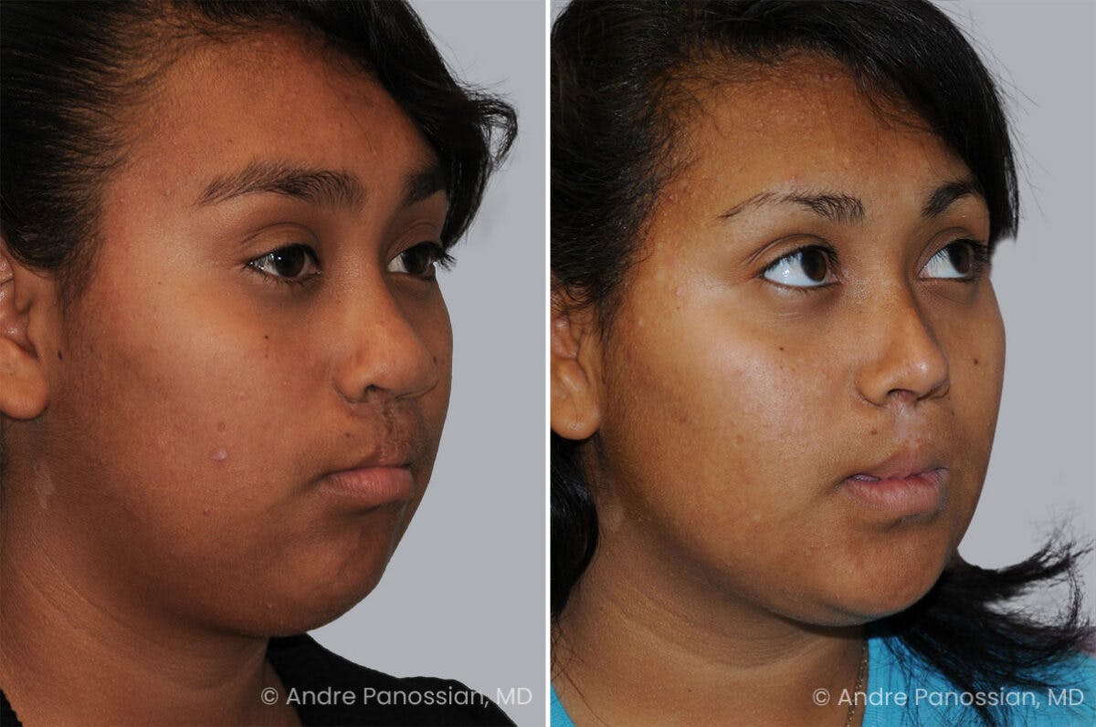 Cleft Lip Rhinoplasty Before & After Gallery - Patient 461917 - Image 3