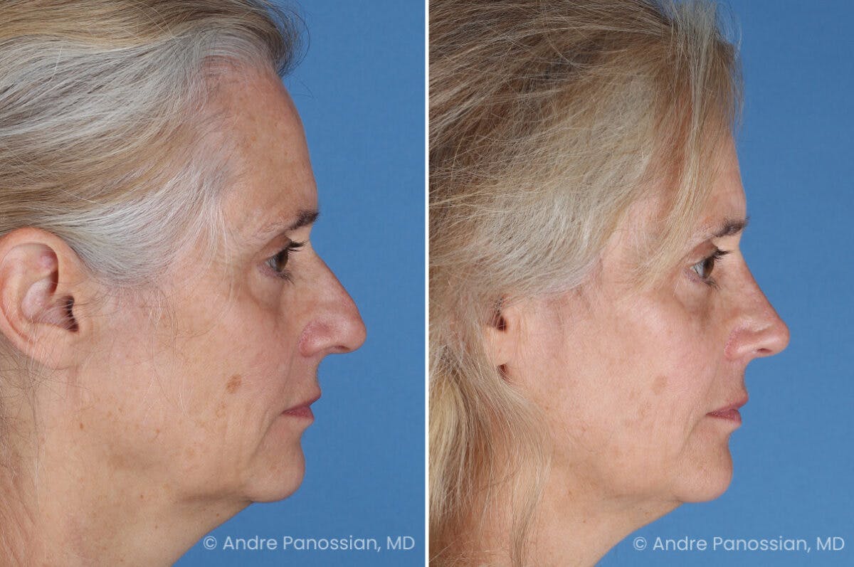 Rhinoplasty Before & After Gallery - Patient 350713 - Image 1