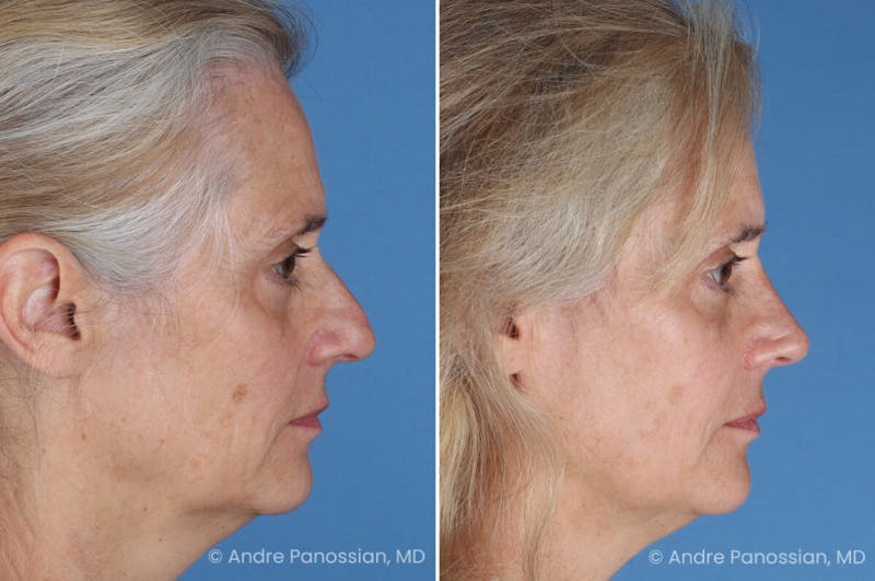Rhinoplasty Before & After Gallery - Patient 350713 - Image 1