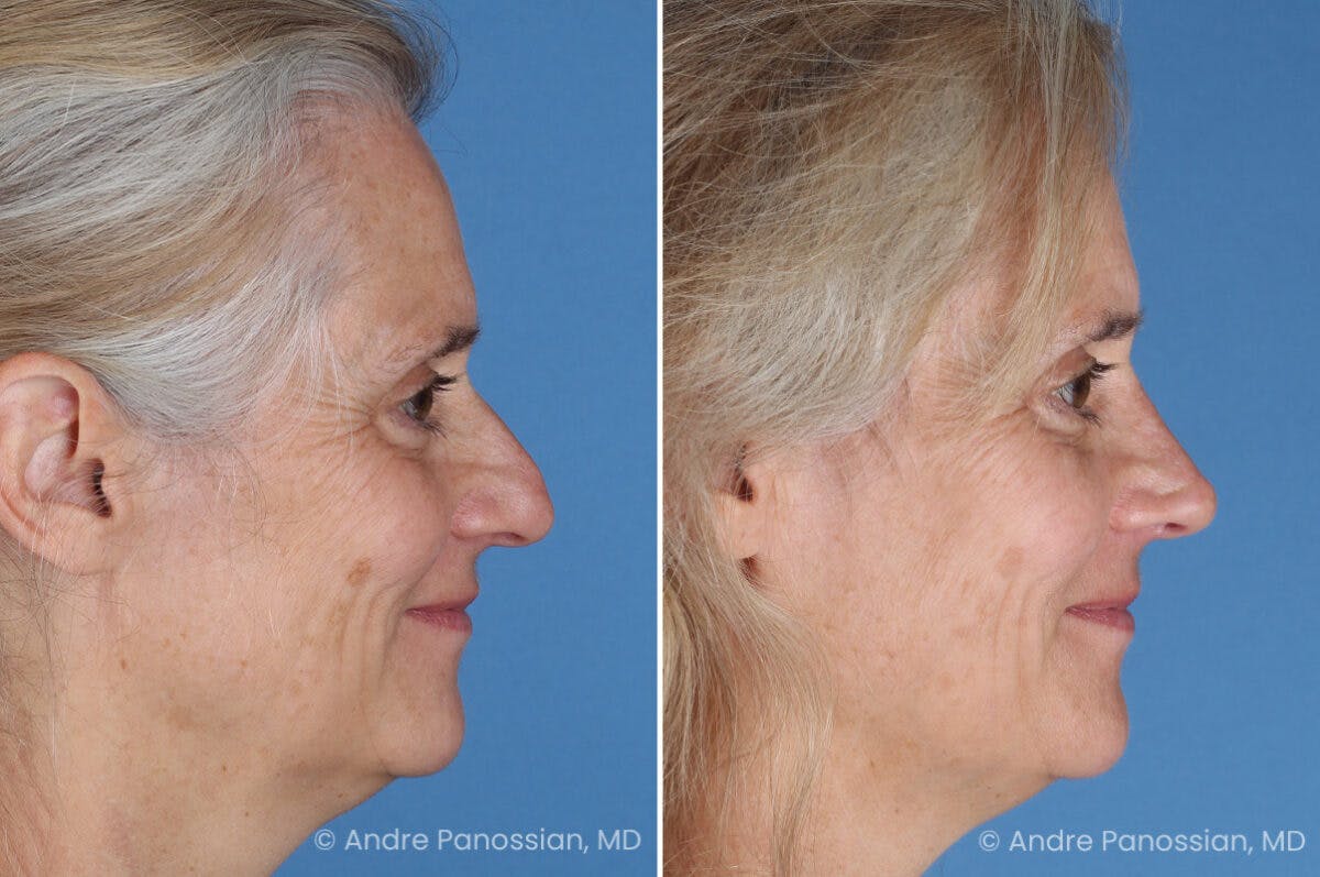 Rhinoplasty Before & After Gallery - Patient 350713 - Image 4