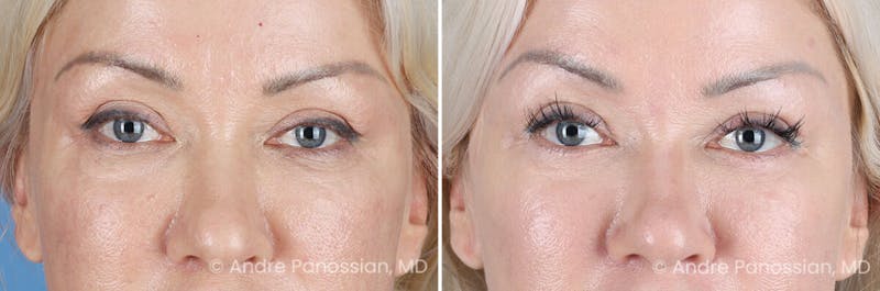 Eyelid Surgery (Blepharoplasty) Before & After Gallery - Patient 145722 - Image 1