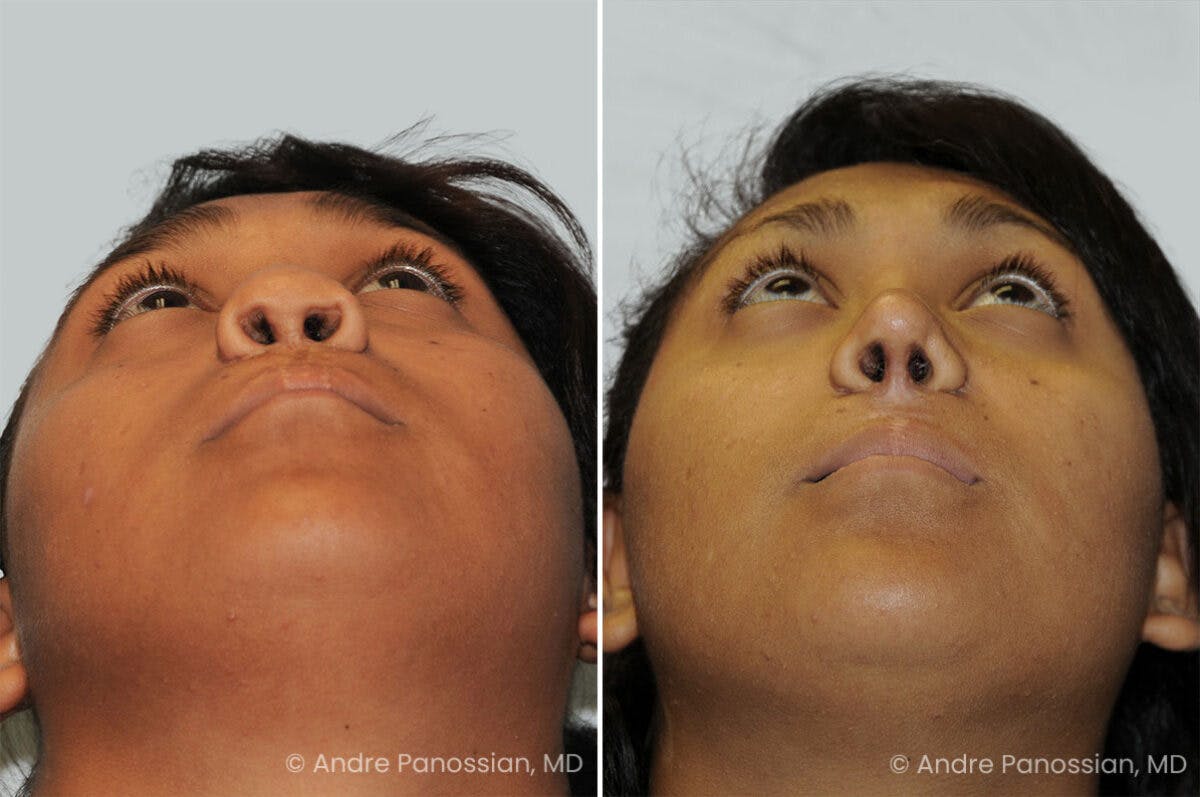 Cleft Lip Rhinoplasty Before & After Gallery - Patient 461917 - Image 4