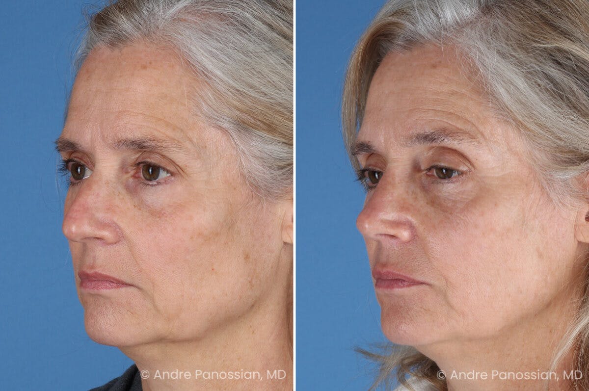 Rhinoplasty Before & After Gallery - Patient 350713 - Image 5