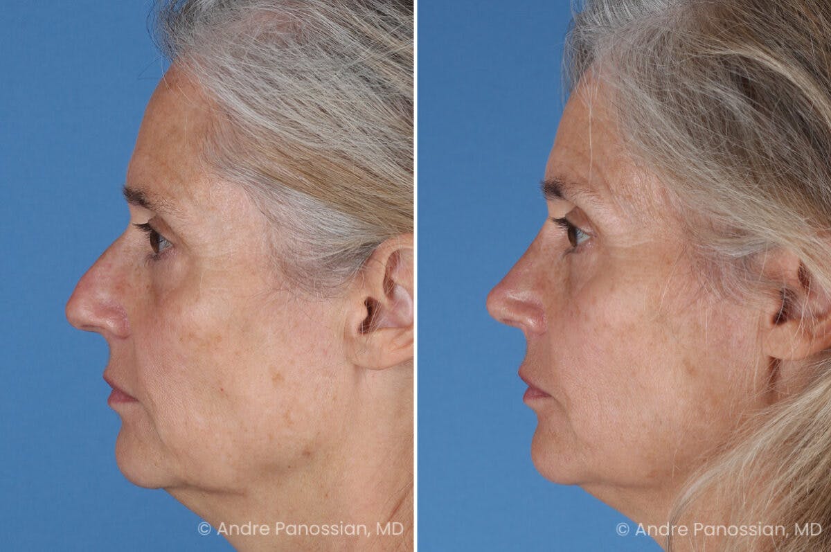 Rhinoplasty Before & After Gallery - Patient 350713 - Image 6