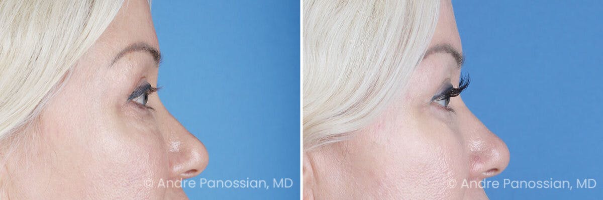 Eyelid Surgery (Blepharoplasty) Before & After Gallery - Patient 145722 - Image 3