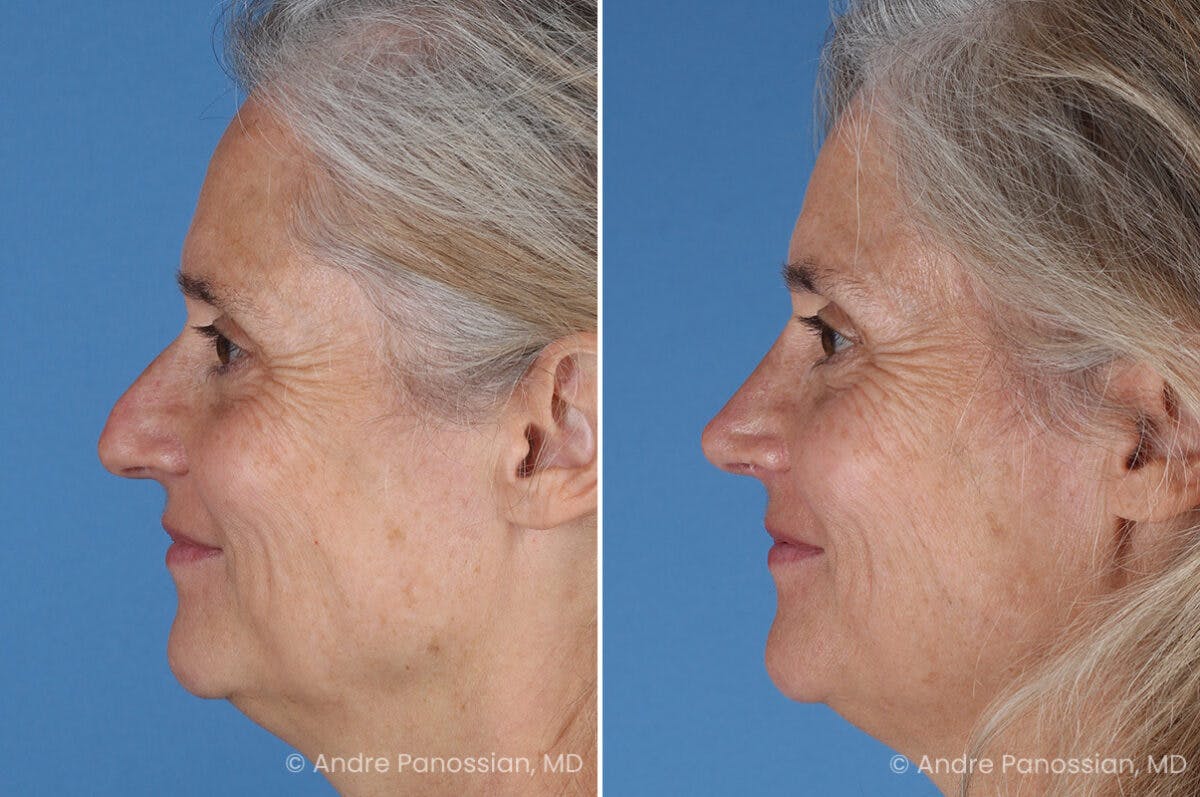 Rhinoplasty Before & After Gallery - Patient 350713 - Image 7