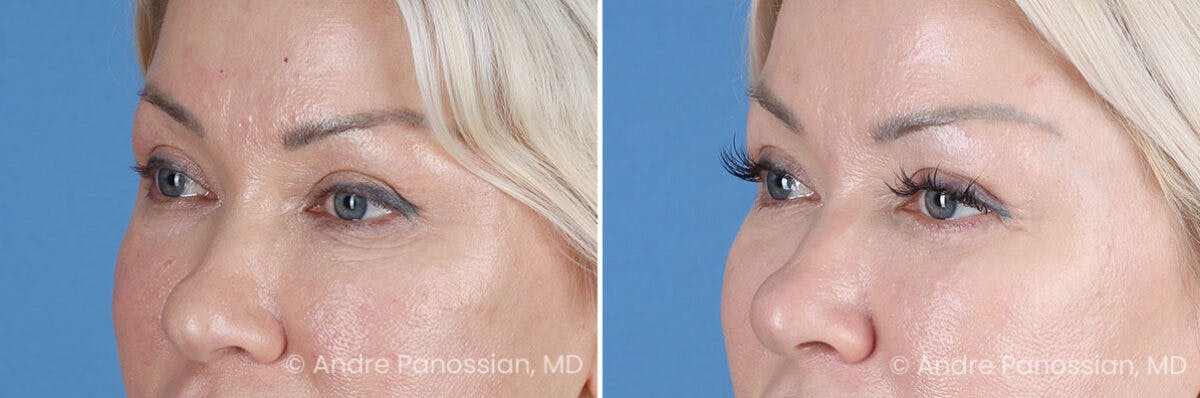 Eyelid Surgery (Blepharoplasty) Before & After Gallery - Patient 145722 - Image 4