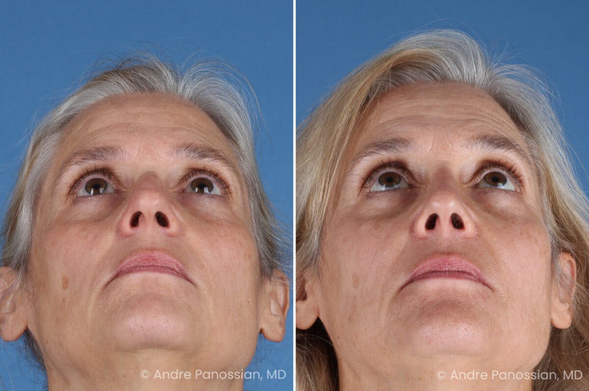 Rhinoplasty Before & After Gallery - Patient 350713 - Image 8