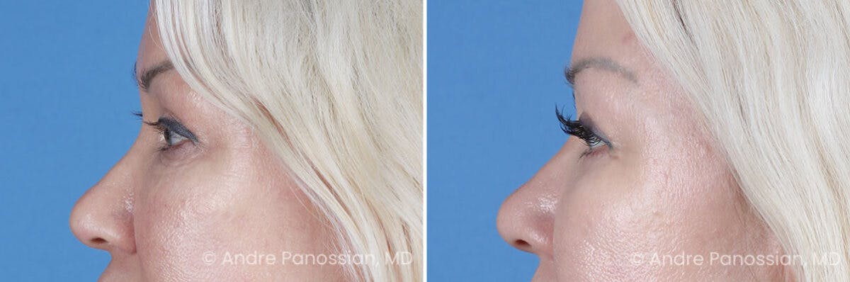 Eyelid Surgery (Blepharoplasty) Before & After Gallery - Patient 145722 - Image 5