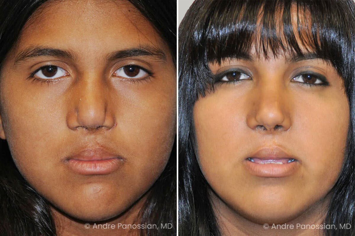 Cleft Lip Rhinoplasty Before & After Gallery - Patient 437208 - Image 2