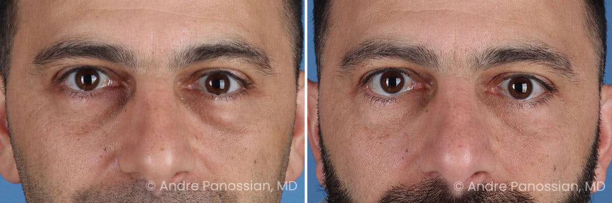 Eyelid Surgery (Blepharoplasty) Before & After Gallery - Patient 175921 - Image 1