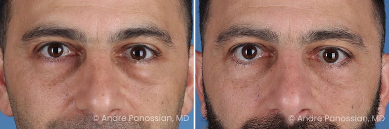 Eyelid Surgery (Blepharoplasty) Before & After Gallery - Patient 175921 - Image 1