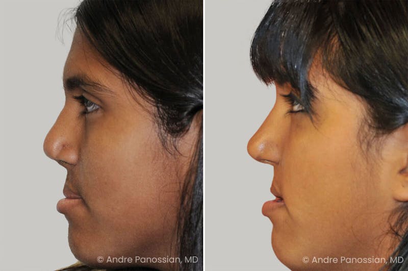 Cleft Lip Rhinoplasty Before & After Gallery - Patient 437208 - Image 1