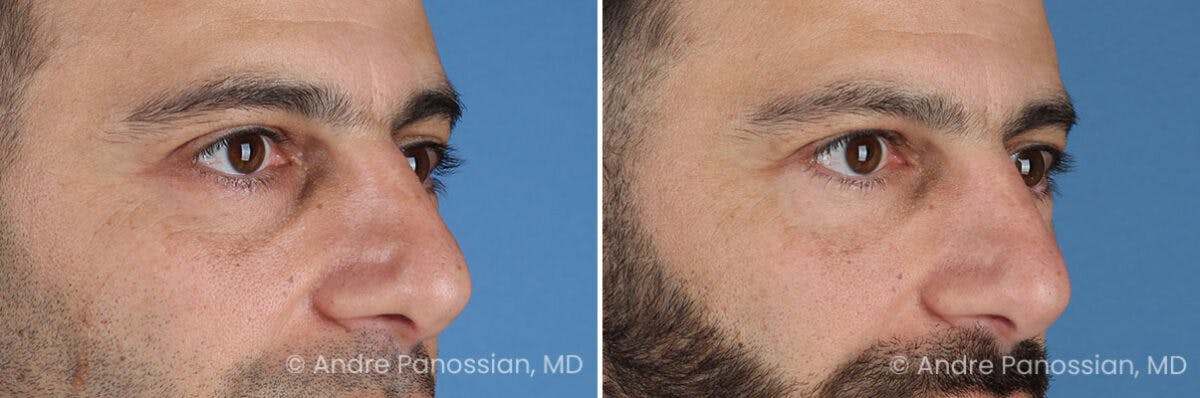 Eyelid Surgery (Blepharoplasty) Before & After Gallery - Patient 175921 - Image 2