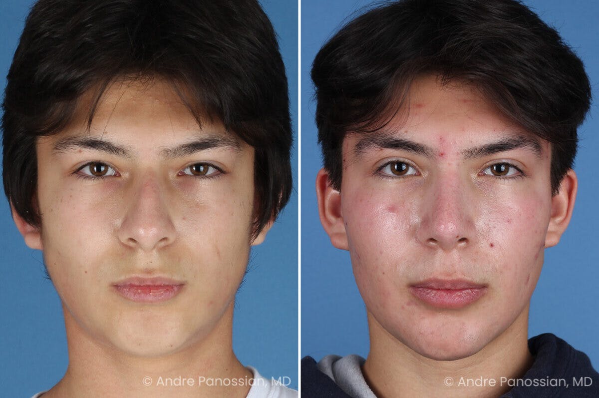 Rhinoplasty Before & After Gallery - Patient 271461 - Image 2