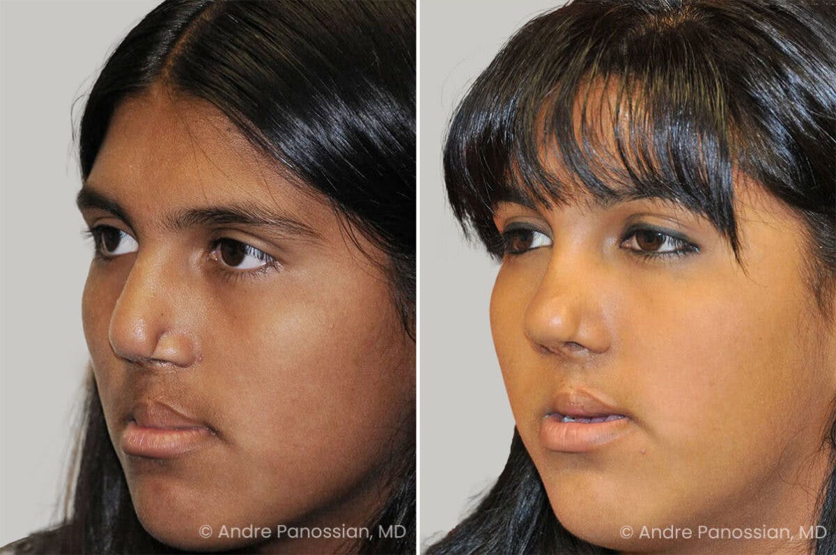 Cleft Lip Rhinoplasty Before & After Gallery - Patient 437208 - Image 3