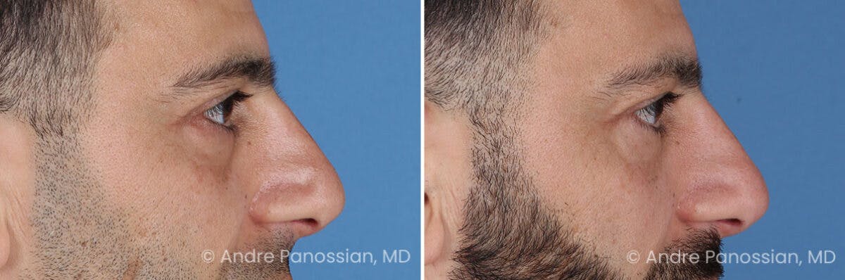 Eyelid Surgery (Blepharoplasty) Before & After Gallery - Patient 175921 - Image 3