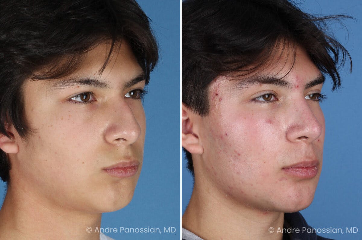 Rhinoplasty Before & After Gallery - Patient 271461 - Image 3