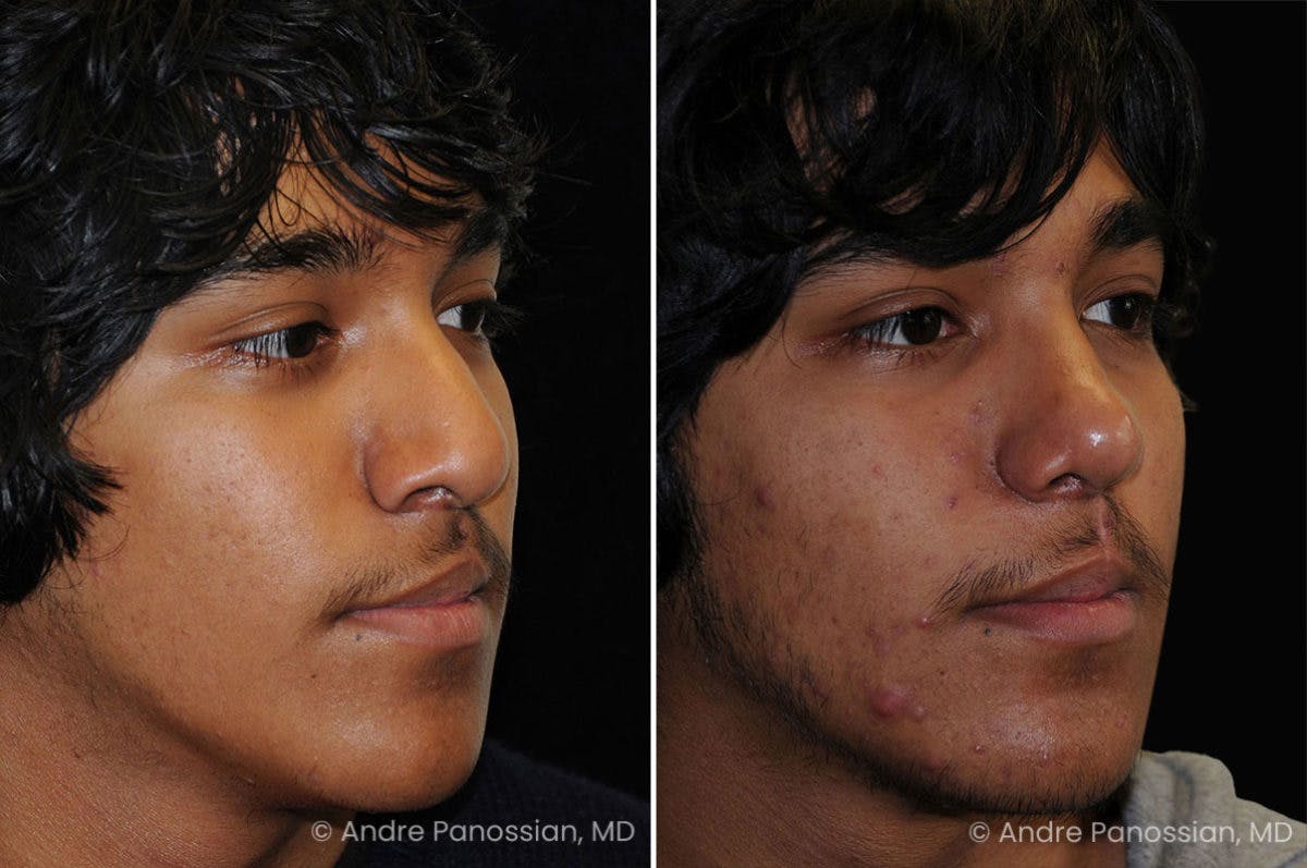 Revision Rhinoplasty Before & After Gallery - Patient 296101 - Image 3
