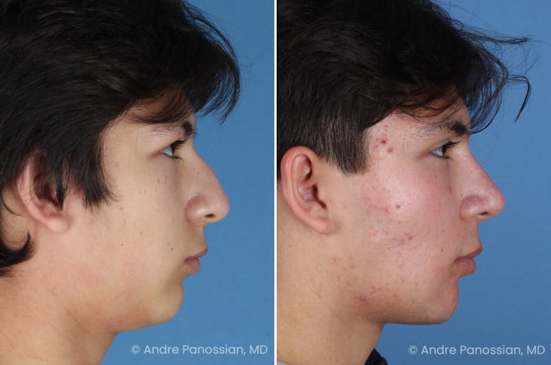 Rhinoplasty Before & After Gallery - Patient 271461 - Image 1
