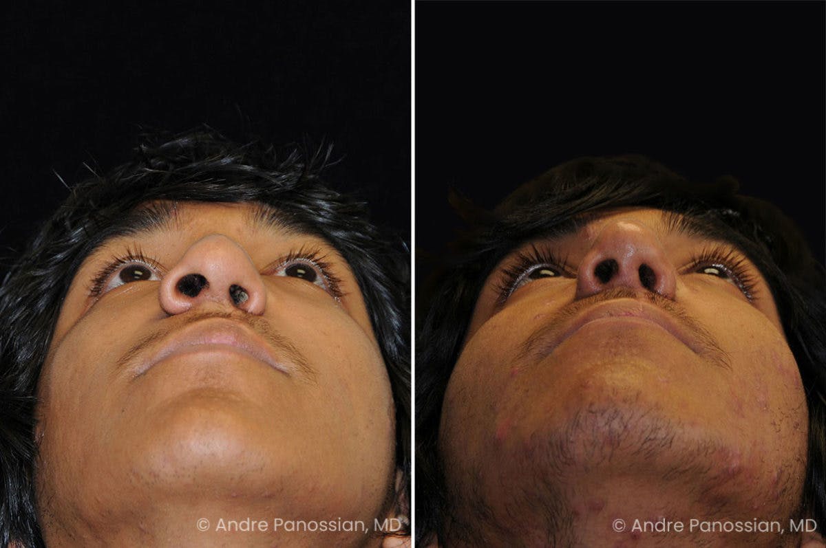 Revision Rhinoplasty Before & After Gallery - Patient 296101 - Image 4