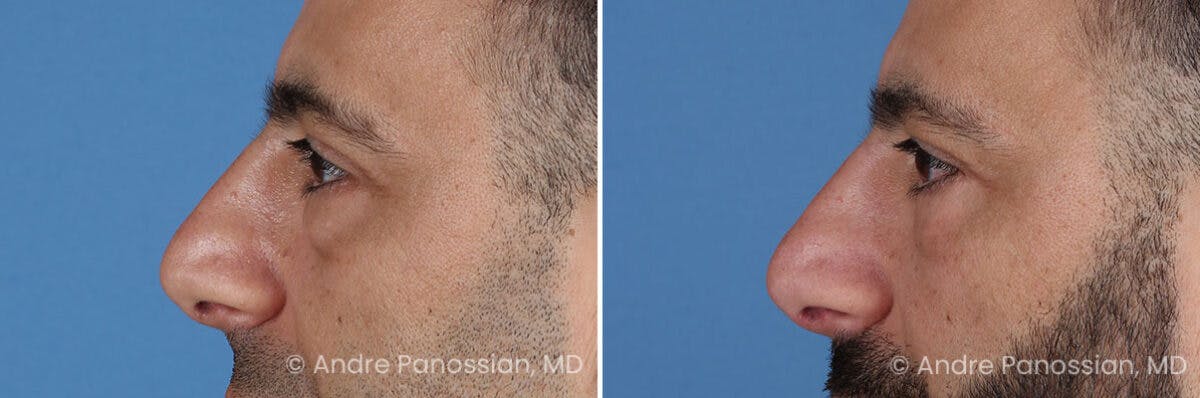 Eyelid Surgery (Blepharoplasty) Before & After Gallery - Patient 175921 - Image 5