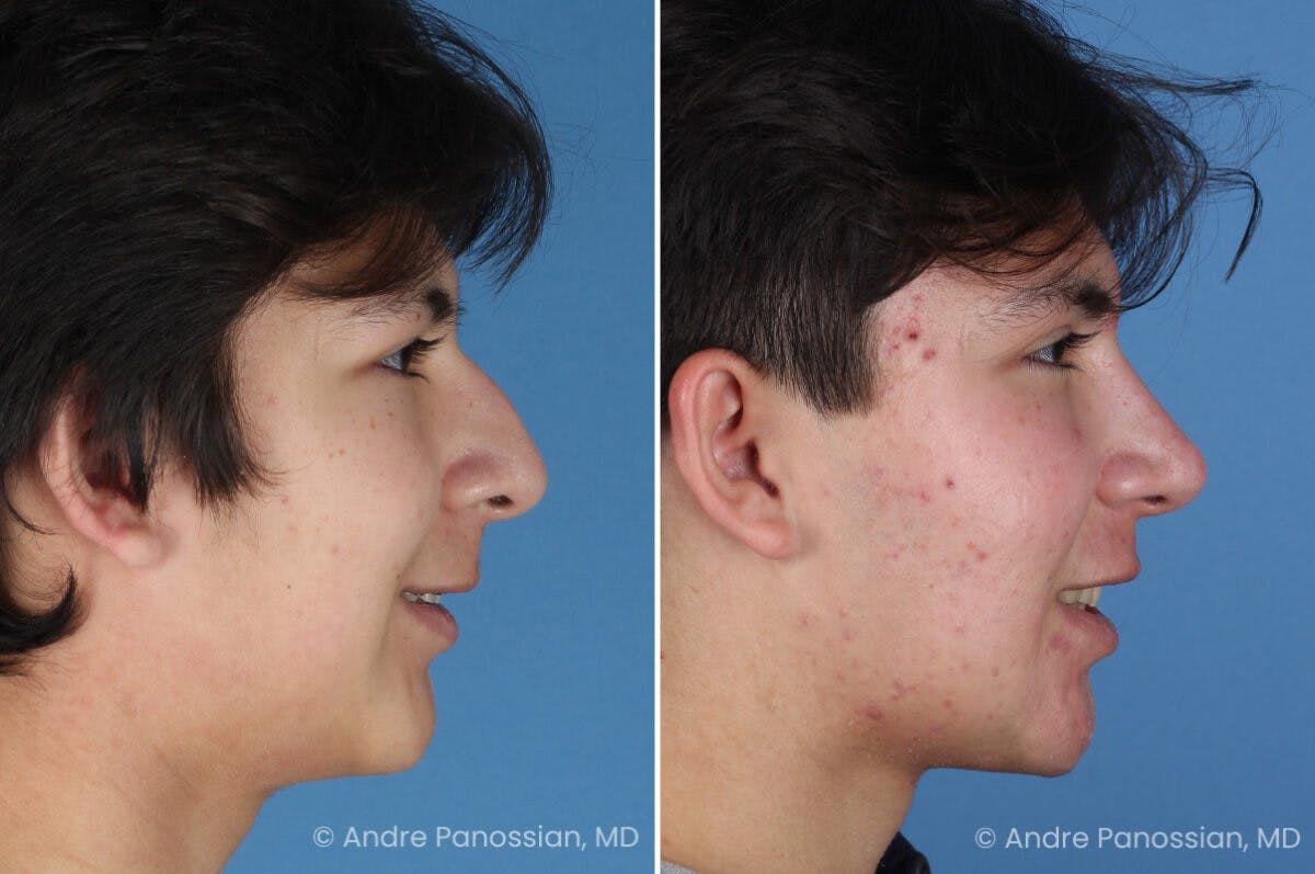 Rhinoplasty Before & After Gallery - Patient 271461 - Image 4