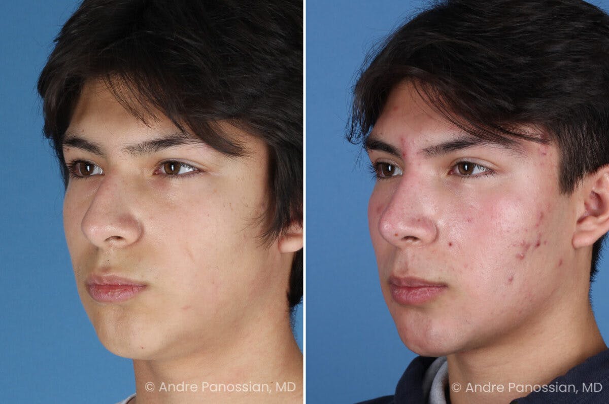 Rhinoplasty Before & After Gallery - Patient 271461 - Image 5