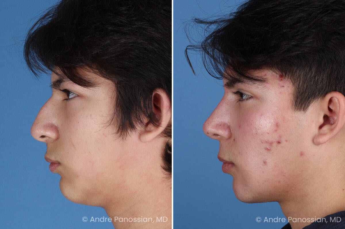 Rhinoplasty Before & After Gallery - Patient 271461 - Image 6