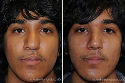 Cleft Lip Rhinoplasty Before & After Photos | Andre Panossian, M.D.