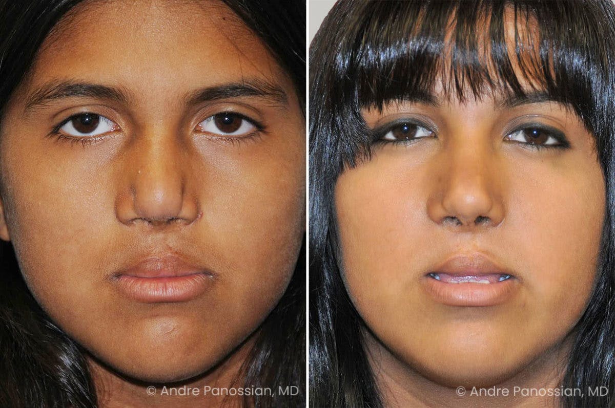 Revision Rhinoplasty Before & After Gallery - Patient 373990 - Image 2