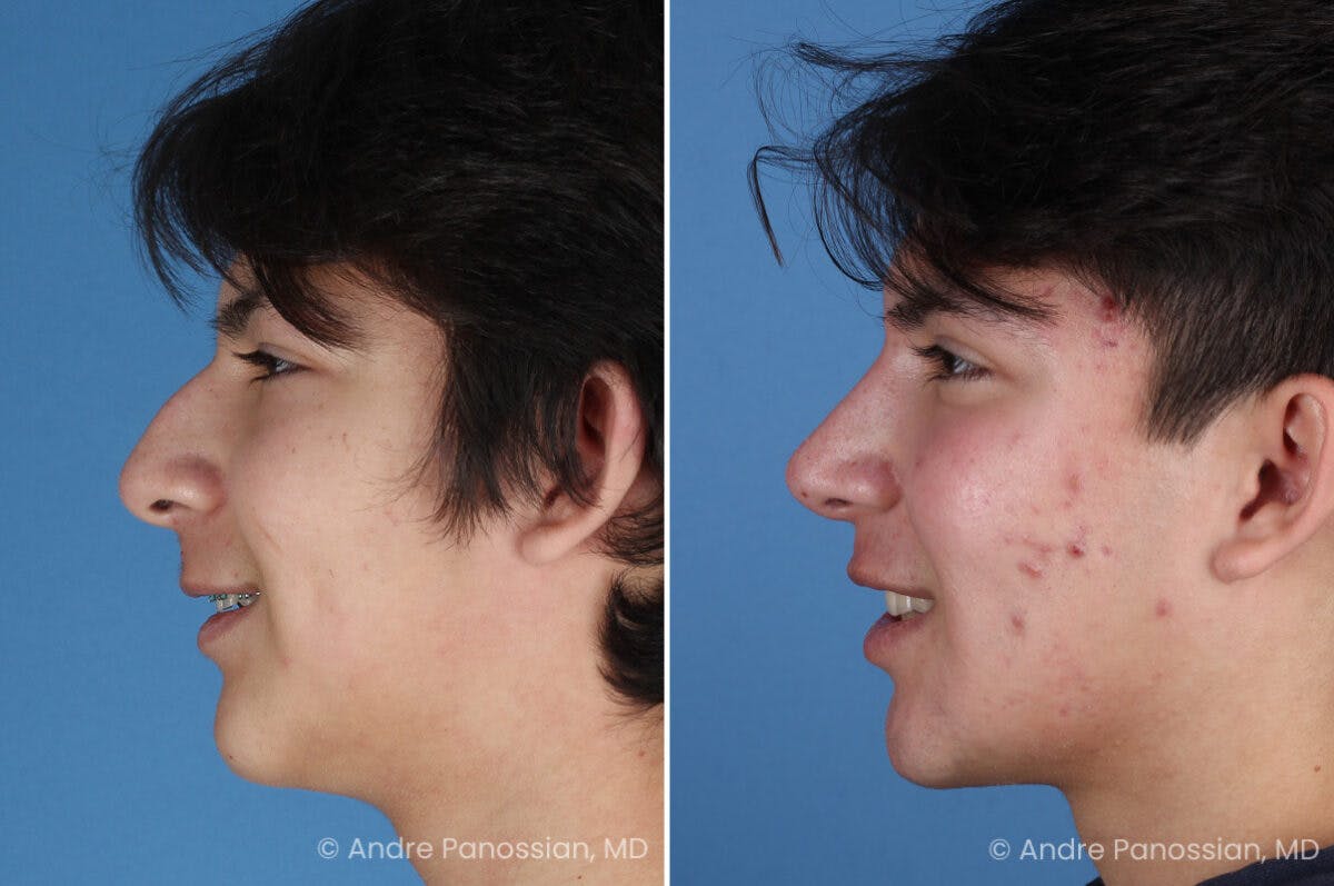 Rhinoplasty Before & After Gallery - Patient 271461 - Image 7