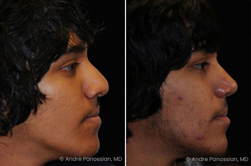 Cleft Lip Rhinoplasty Before & After Gallery - Patient 350584 - Image 1