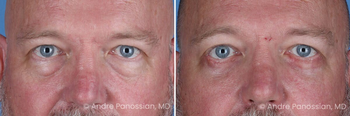 Eyelid Surgery (Blepharoplasty) Before & After Gallery - Patient 162428 - Image 1