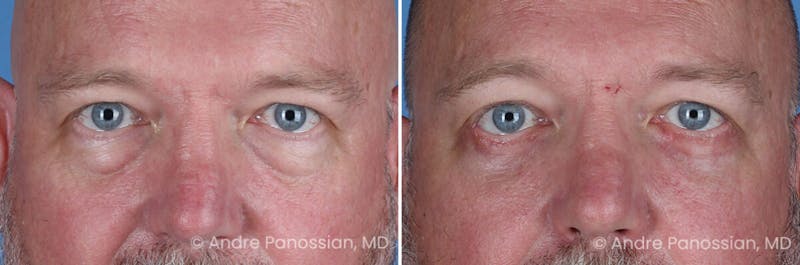 Eyelid Surgery (Blepharoplasty) Before & After Gallery - Patient 162428 - Image 1