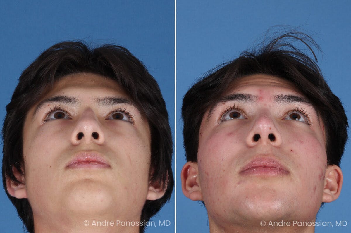 Rhinoplasty Before & After Gallery - Patient 271461 - Image 8